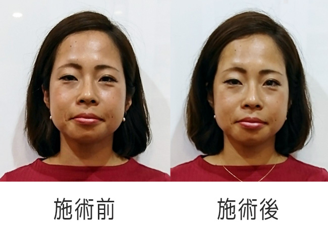 美容鍼