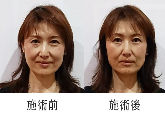 美容鍼 横浜